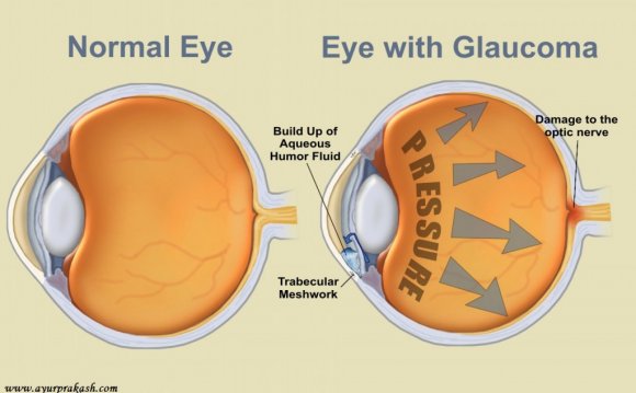 Glaucoma treatment in Ayurveda