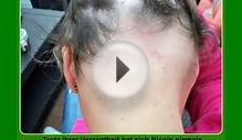 Alopecia Areata - Haarausfall STOP und neuer Haarwuchs