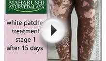 ayurveda treatment for white patches/vitiligo/leucoderma
