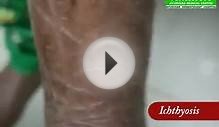 Ichthyosis Treatment in Kerala | Ayurvedic Skin Clinic Kochi