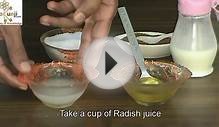 Piles (Hemorrhoids) Treatment - Natural Internal and