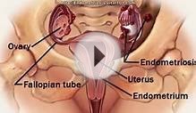 Treatment For Endometriosis Review | Is Treatment For
